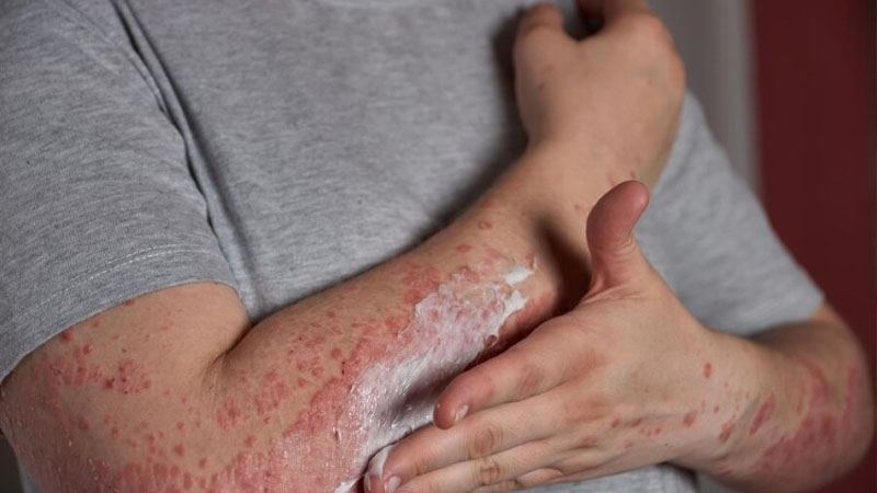 Mengenal Penyakit Lupus, Gejala Khas dan Pilihan Penanganannya – PAFI Kab. Kapuas Hulu